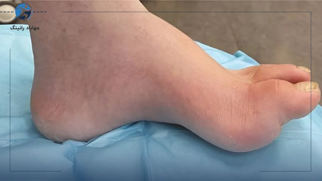 پشتیبانی از قوس پا